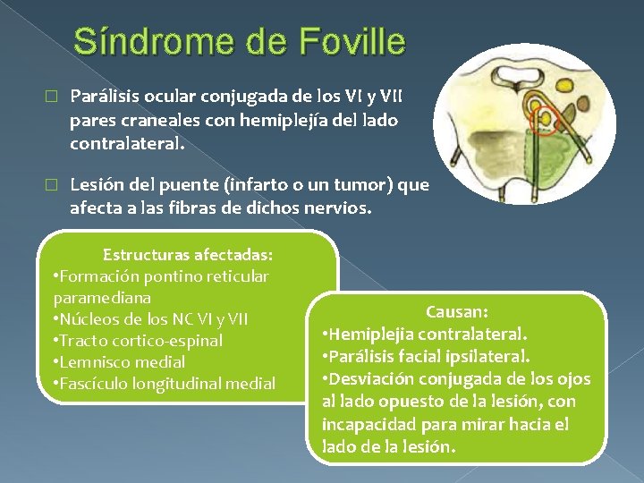 Síndrome de Foville � Parálisis ocular conjugada de los VI y VII pares craneales