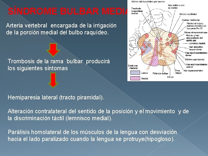 SÍNDROME BULBAR MEDIAL Arteria vertebral encargada de la irrigación de la porción medial del