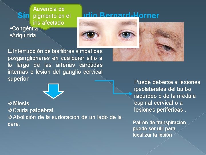 Ausencia de pigmento en el Síndrome de Claudio Bernard-Horner iris afectado. §Congénita §Adquirida q.