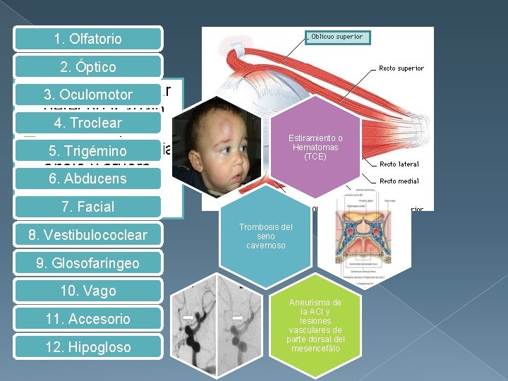 1. Olfatorio 2. Óptico � 3. Diplopía → mirar Oculomotor derecho y abajo 4.