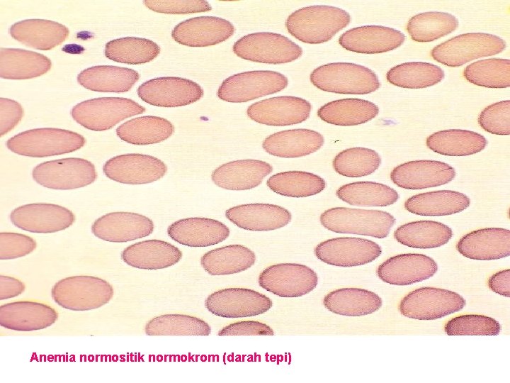 Anemia normositik normokrom (darah tepi) 