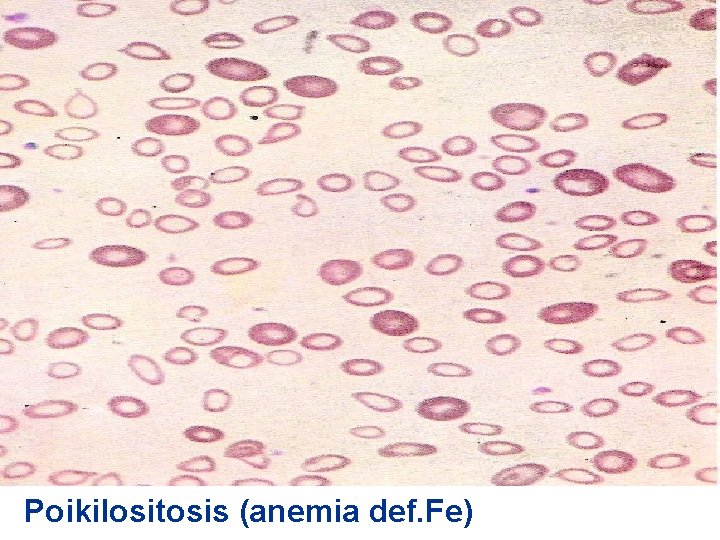 Poikilositosis (anemia def. Fe) 