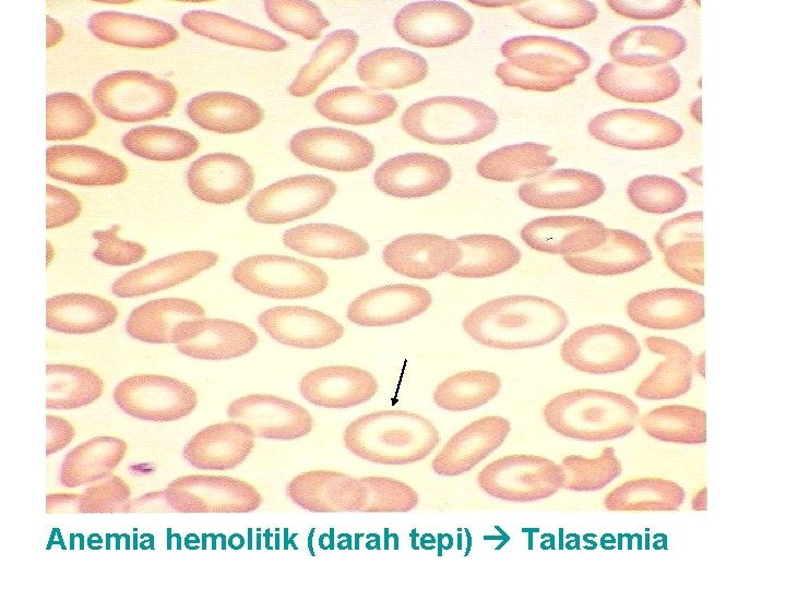 Anemia hemolitik (darah tepi) Talasemia 