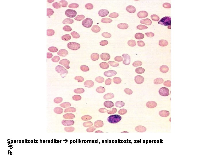 Sperositosis herediter polikromasi, anisositosis, sel sperosit SS p 