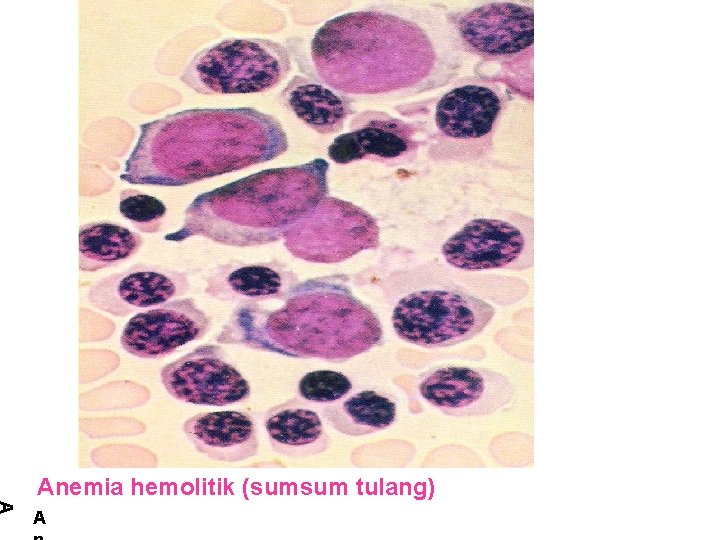 Anemia hemolitik (sumsum tulang) A 