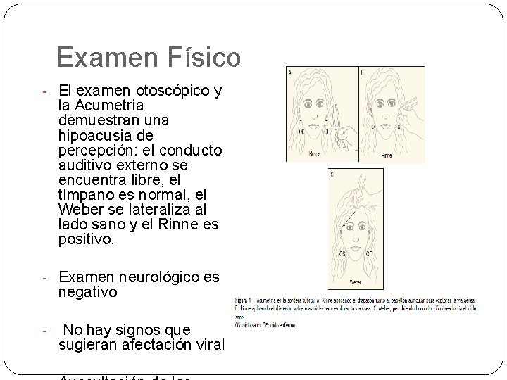 Examen Físico - El examen otoscópico y la Acumetria demuestran una hipoacusia de percepción: