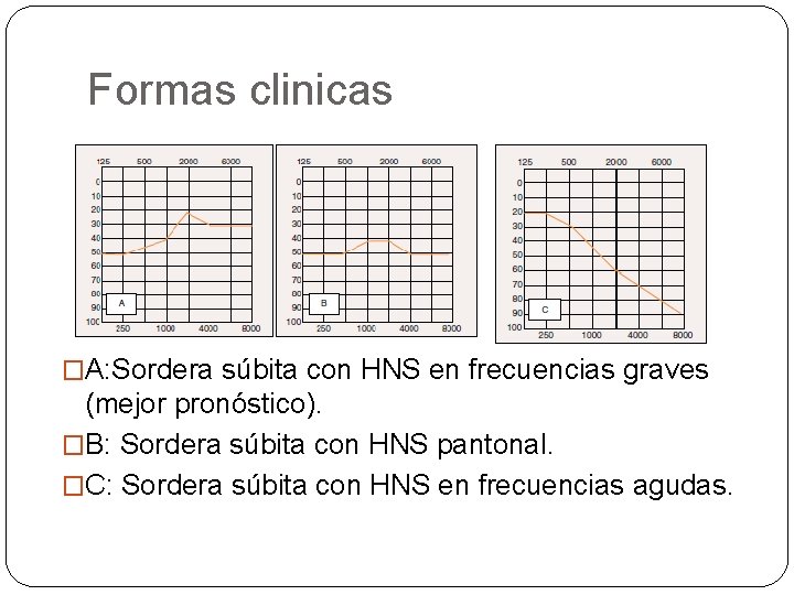 Formas clinicas �A: Sordera súbita con HNS en frecuencias graves (mejor pronóstico). �B: Sordera