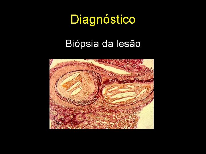 Diagnóstico Biópsia da lesão 