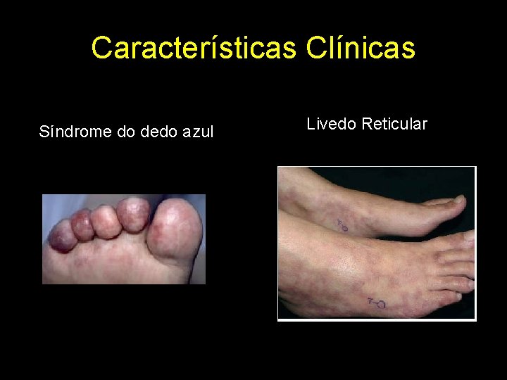Características Clínicas Síndrome do dedo azul Livedo Reticular 