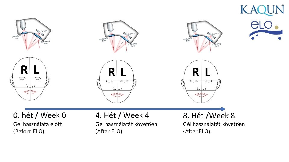 R L 0. hét / Week 0 Gél használata előtt (Before ELO) R L