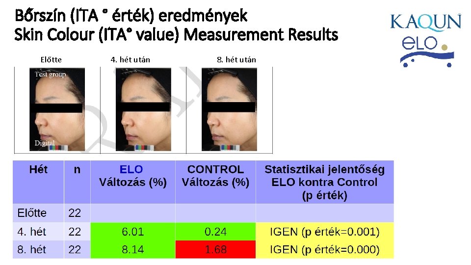 Bőrszín (ITA ° érték) eredmények Skin Colour (ITA° value) Measurement Results Előtte 4. hét