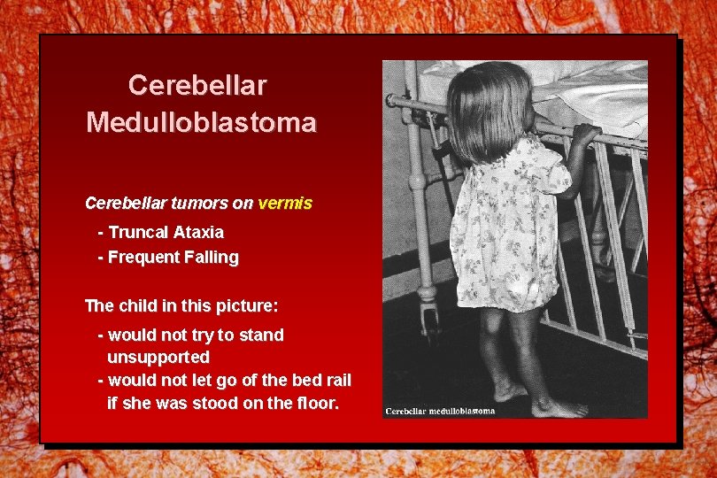 Cerebellar Medulloblastoma Cerebellar tumors on vermis - Truncal Ataxia - Frequent Falling The child