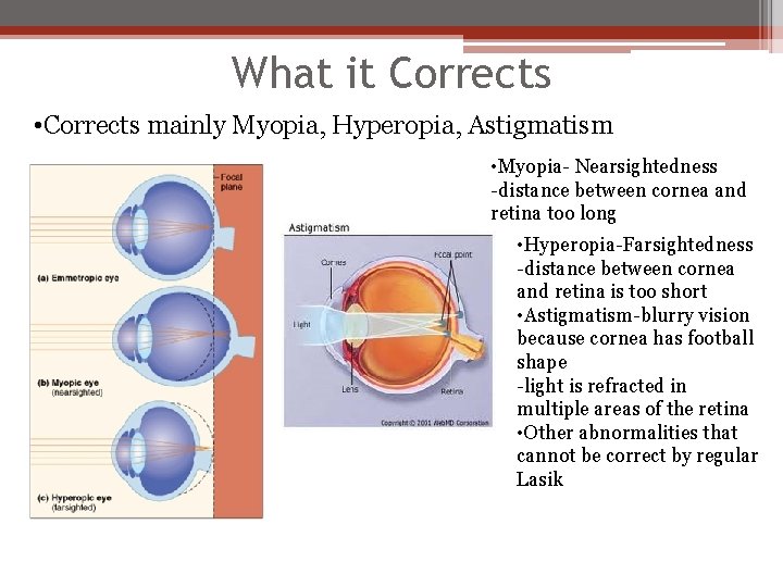 What it Corrects • Corrects mainly Myopia, Hyperopia, Astigmatism • Myopia- Nearsightedness -distance between