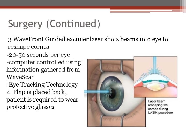 Surgery (Continued) 3. Wave. Front Guided excimer laser shots beams into eye to reshape