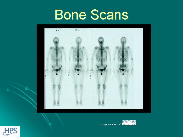 Bone Scans Image courtesy of 