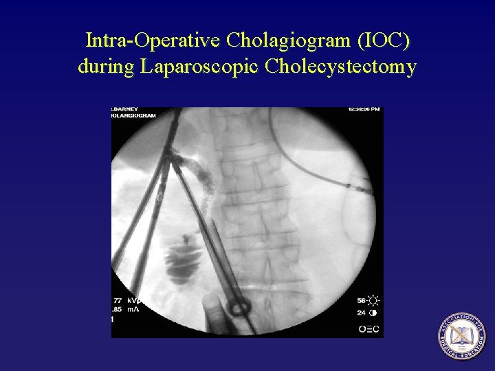 Intra-Operative Cholagiogram (IOC) during Laparoscopic Cholecystectomy 