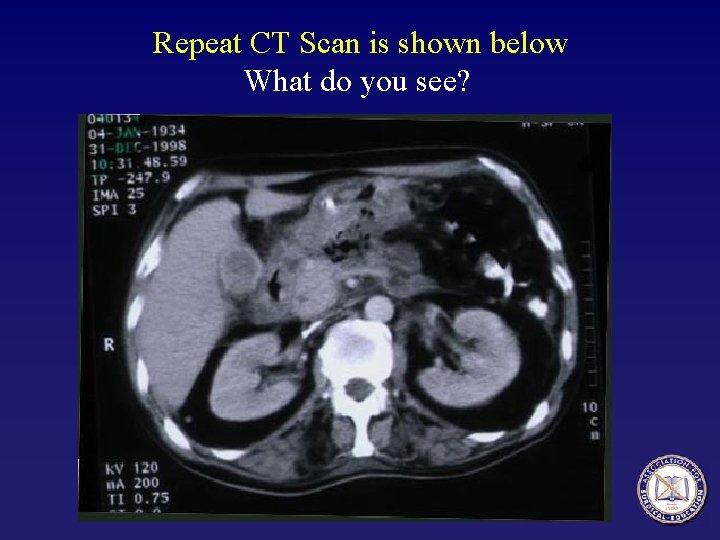 Repeat CT Scan is shown below What do you see? 