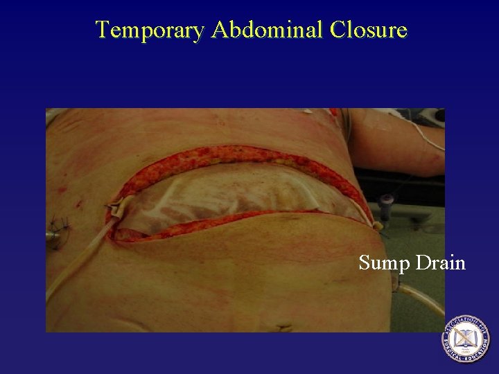 Temporary Abdominal Closure Sump Drain 