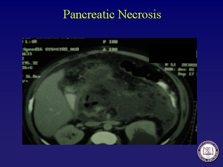 Pancreatic Necrosis 