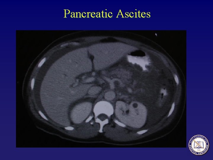 Pancreatic Ascites 