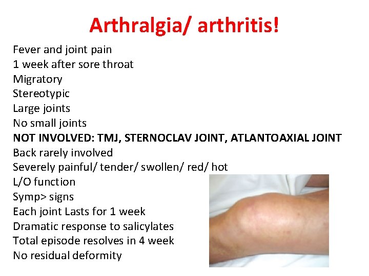 Arthralgia/ arthritis! Fever and joint pain 1 week after sore throat Migratory Stereotypic Large