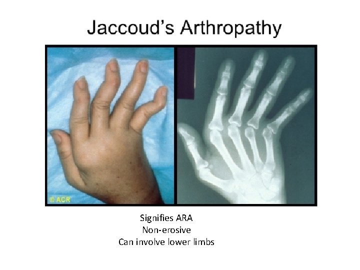 Signifies ARA Non-erosive Can involve lower limbs 