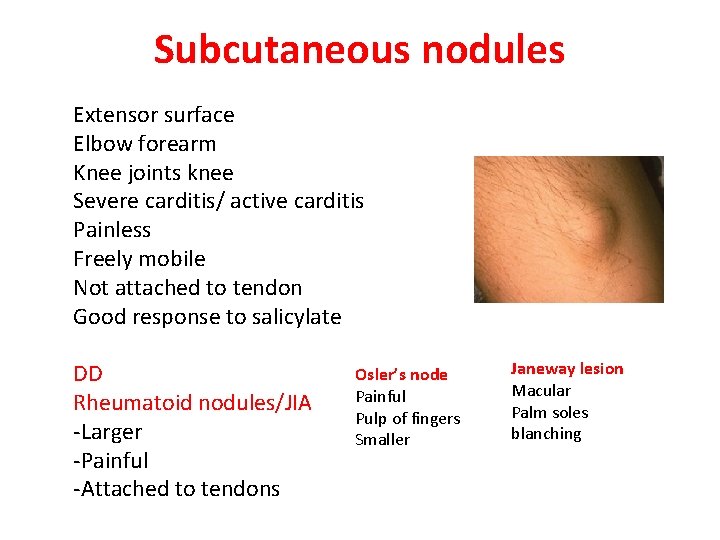 Subcutaneous nodules Extensor surface Elbow forearm Knee joints knee Severe carditis/ active carditis Painless