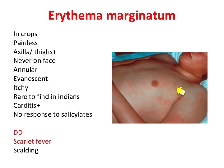 Erythema marginatum In crops Painless Axilla/ thighs+ Never on face Annular Evanescent Itchy Rare