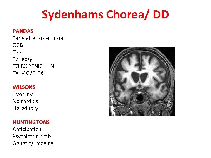 Sydenhams Chorea/ DD PANDAS Early after sore throat OCD Tics Epilepsy TO RX PENICILLIN