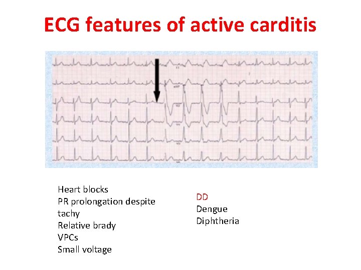 ECG features of active carditis Heart blocks PR prolongation despite tachy Relative brady VPCs
