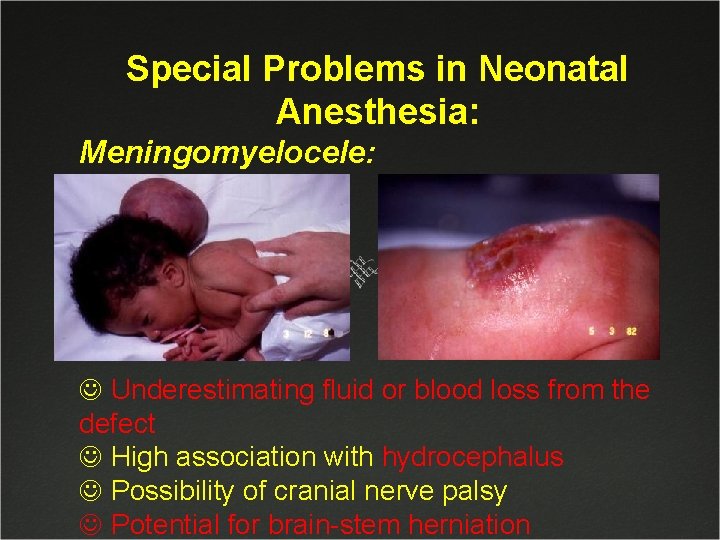 Special Problems in Neonatal Anesthesia: Meningomyelocele: J Underestimating fluid or blood loss from the