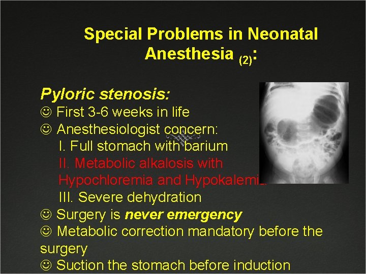 Special Problems in Neonatal Anesthesia (2): Pyloric stenosis: J First 3 -6 weeks in