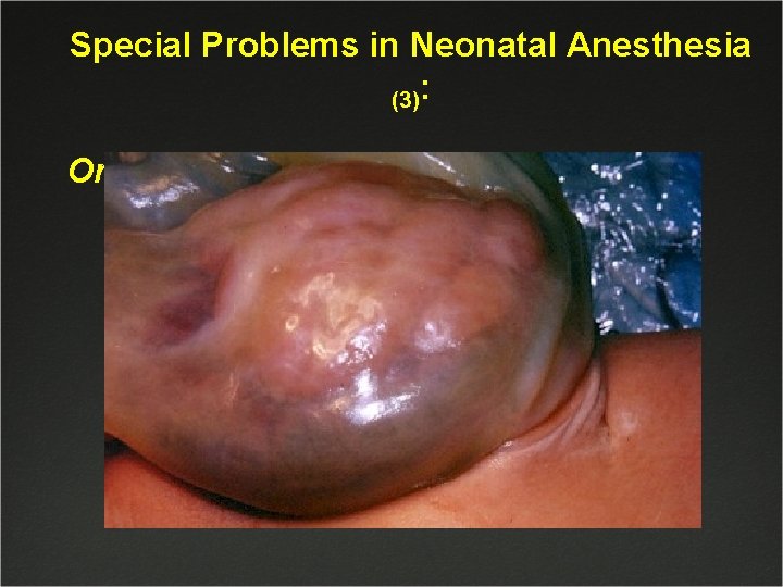 Special Problems in Neonatal Anesthesia (3): Omphalocele 