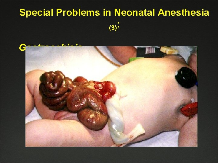 Special Problems in Neonatal Anesthesia (3): Gastroschisis 
