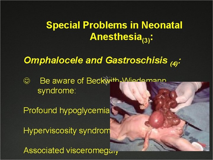 Special Problems in Neonatal Anesthesia(3): Omphalocele and Gastroschisis (4): J Be aware of Beckwith-Wiedemann