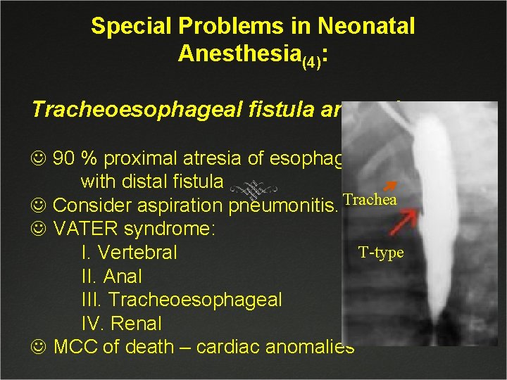 Special Problems in Neonatal Anesthesia(4): Tracheoesophageal fistula anomaly(1): J 90 % proximal atresia of