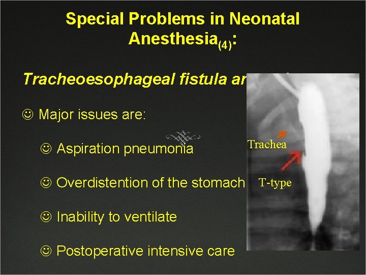 Special Problems in Neonatal Anesthesia(4): Tracheoesophageal fistula anomaly(2): J Major issues are: J Aspiration