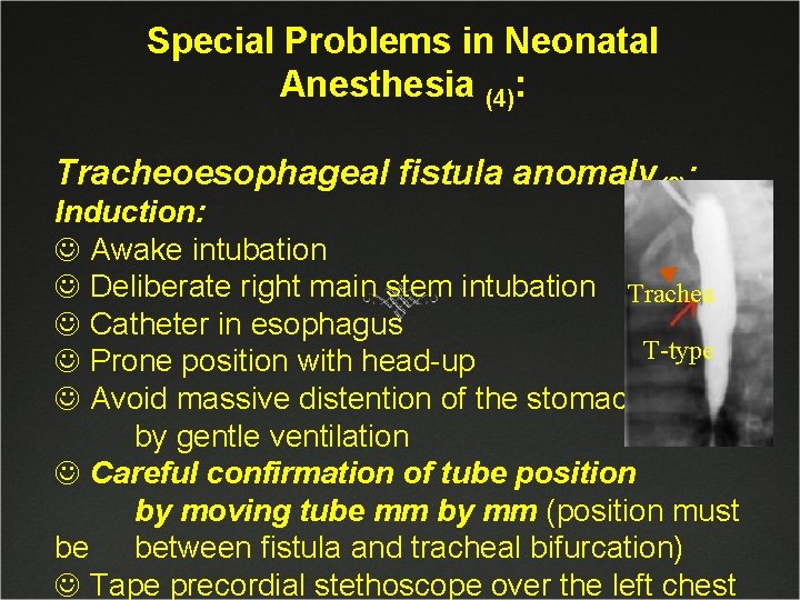 Special Problems in Neonatal Anesthesia (4): Tracheoesophageal fistula anomaly(3): Induction: J Awake intubation J