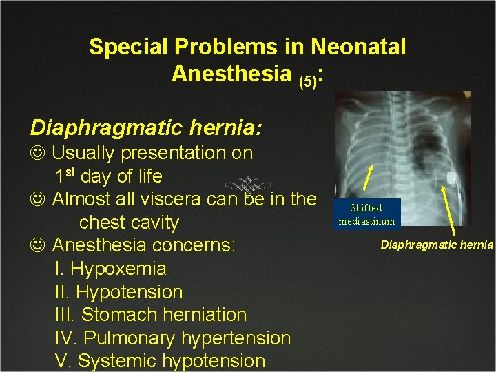 Special Problems in Neonatal Anesthesia (5): Diaphragmatic hernia: J Usually presentation on 1 st