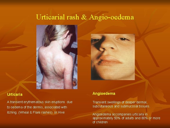 Urticarial rash & Angio-oedema Urticaria Angioedema A transient erythematous skin eruptions due Transient swellings