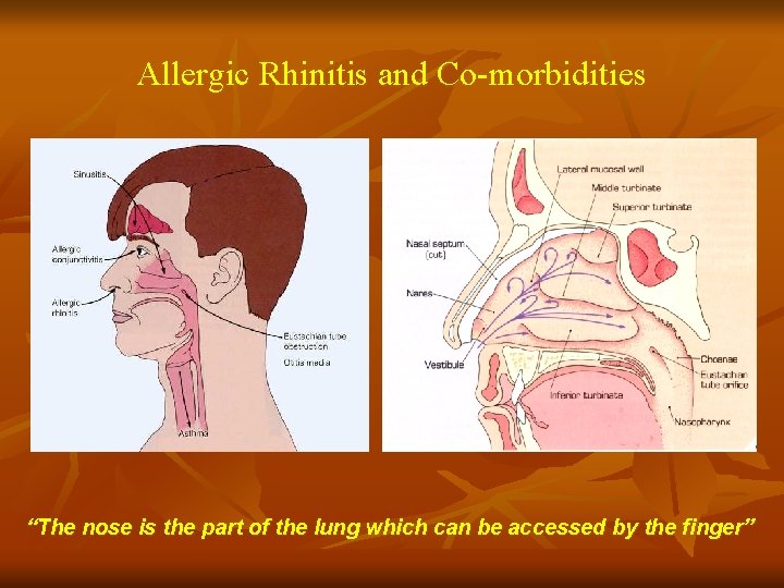 Allergic Rhinitis and Co-morbidities “The nose is the part of the lung which can