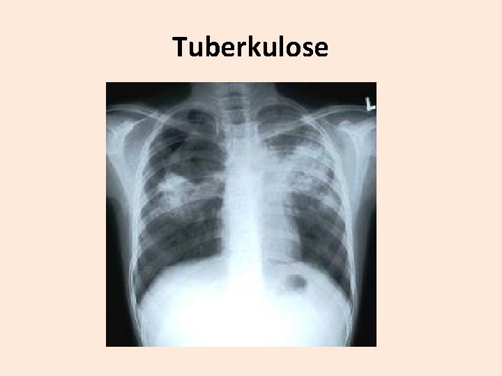 Tuberkulose 