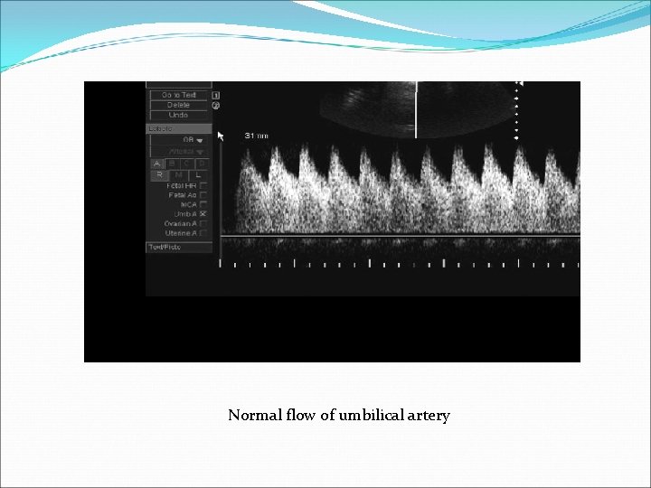 Normal flow of umbilical artery 