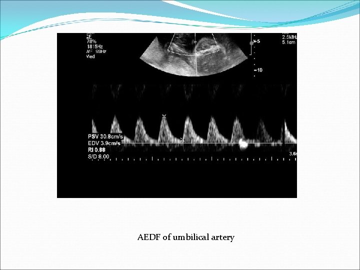 AEDF of umbilical artery 