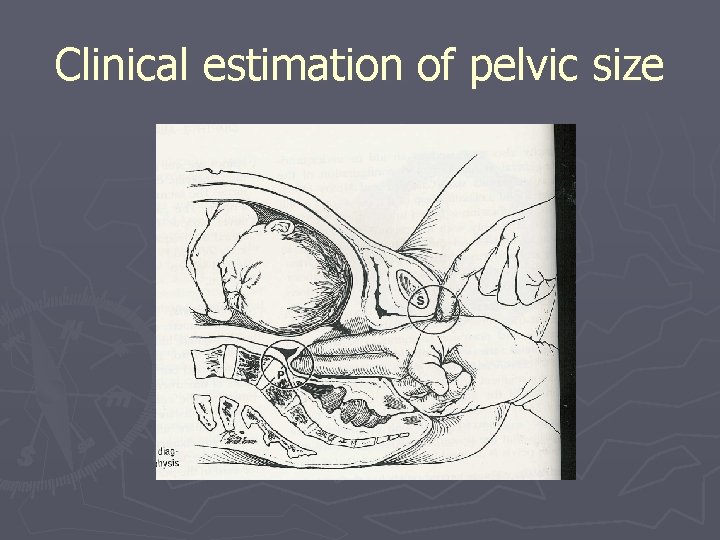 Clinical estimation of pelvic size 