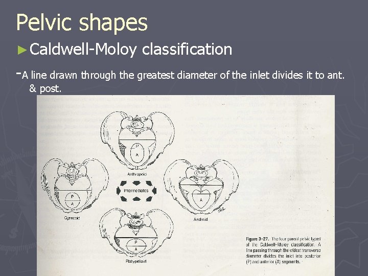 Pelvic shapes ► Caldwell-Moloy classification -A line drawn through the greatest diameter of the