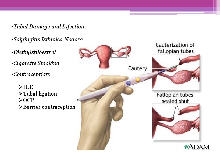  • Tubal Damage and Infection • Salpingitis Isthmica Nodosa • Diethylstilbestrol • Cigarette