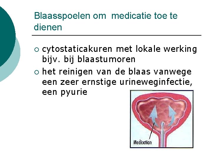 Blaasspoelen om medicatie toe te dienen cytostaticakuren met lokale werking bijv. bij blaastumoren ¡