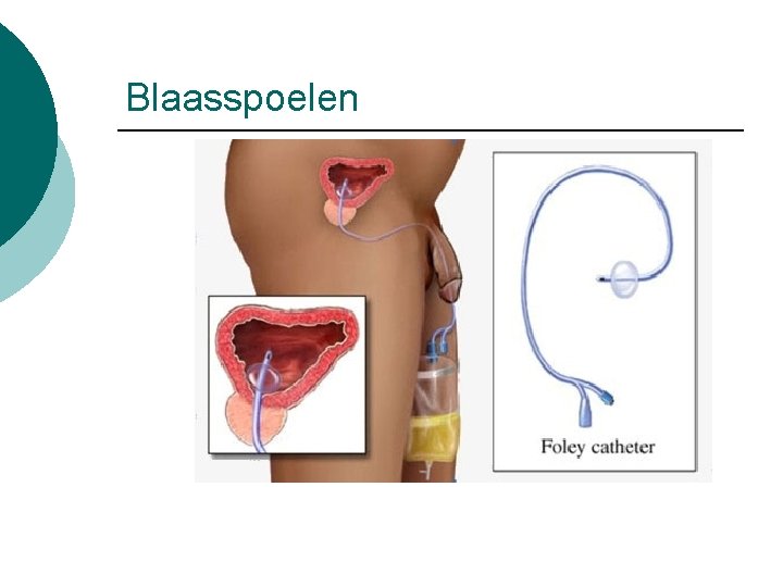 Blaasspoelen 