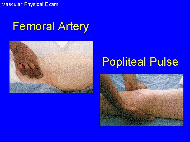 Vascular Physical Exam Femoral Artery Popliteal Pulse 